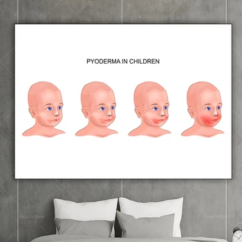 Пиодермия на лице младенца векторное изображение декоративный плакат с принтом на холсте